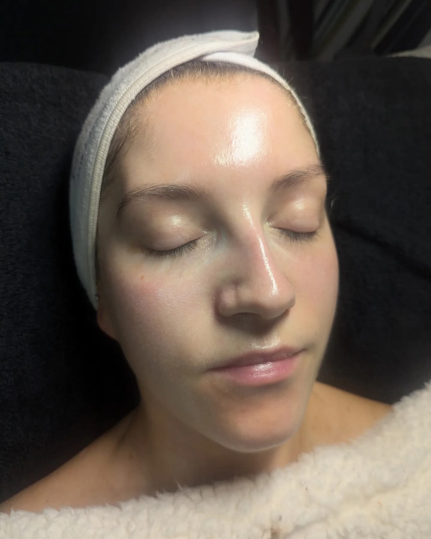 Chemical Peels